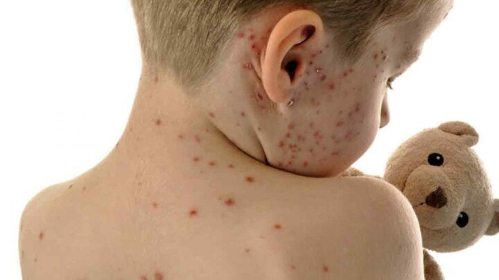 واکسیناسیون سرخک در کشورهای جهان/ کدام کشورها سرخک را حذف کردهاند؟/ وضعیت ایران