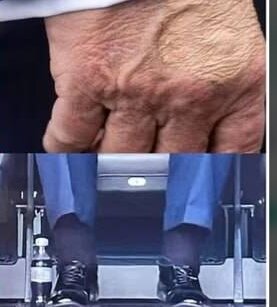 بیماری ترامپ چیست؟ چرا رییس‌جمهور آمریکا بند کفش‌هایش را نصفه بسته بود؟/ عکس