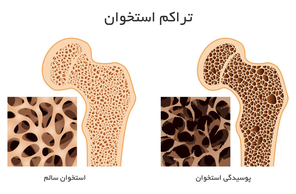 برای افزایش تراکم استخوان چه بخوریم؟/ نمونه برنامه غذایی روزانه مبتلایان به استئوپنی/ ورزش‌های مناسب تراکم استخوان 